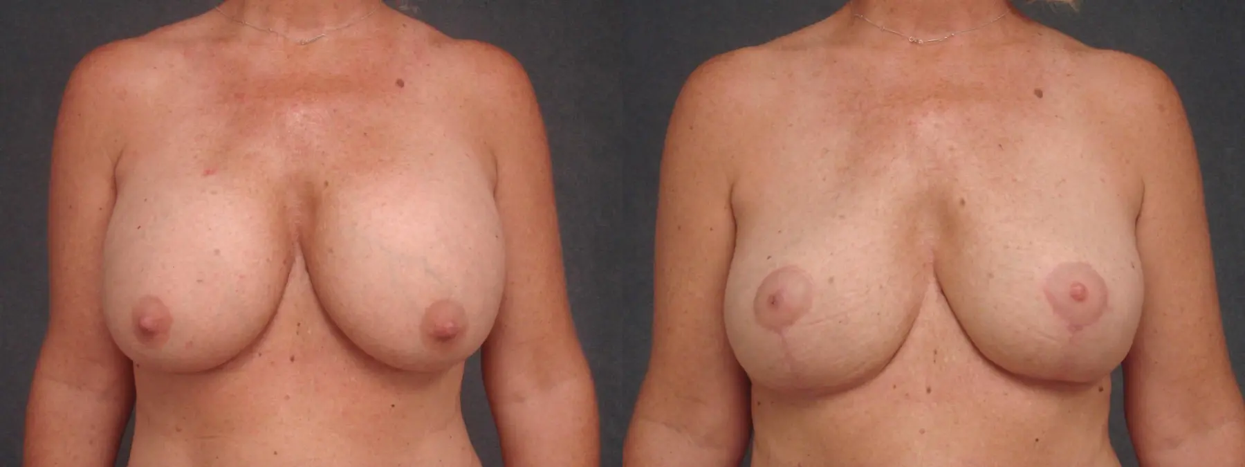 Breast Implant Removal With Lift: Patient 2 - Before and After  