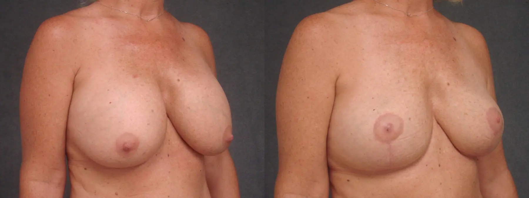 Breast Implant Removal With Lift: Patient 2 - Before and After 2