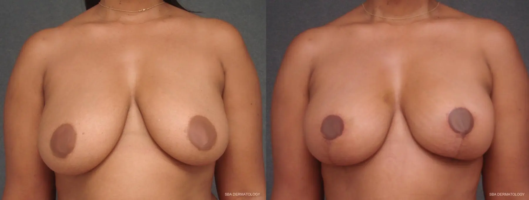 Breast Lift: Patient 1 - Before and After 1