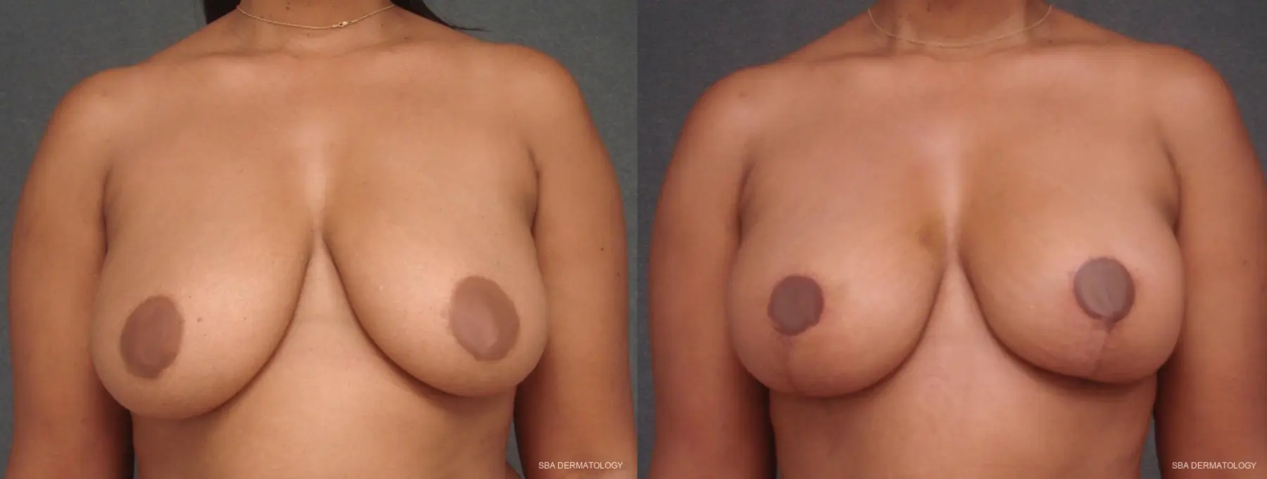 Breast Lift: Patient 1 - Before and After  