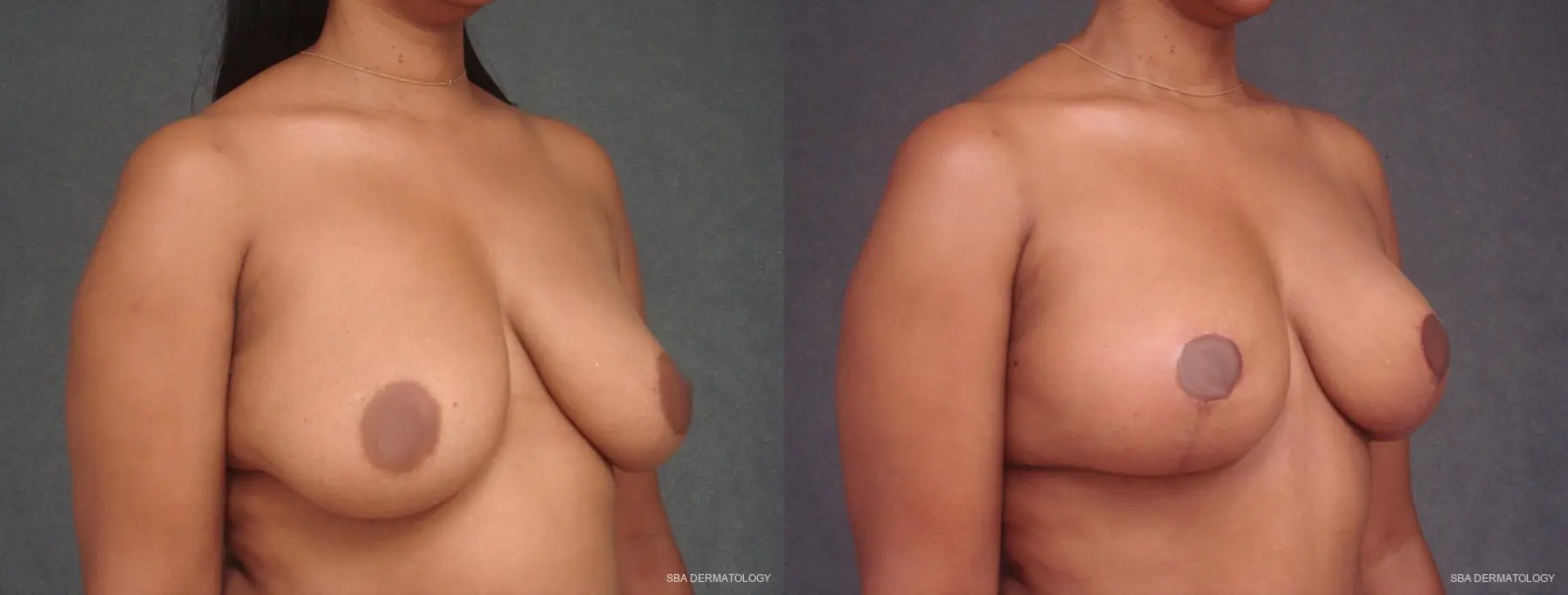 Breast Lift: Patient 1 - Before and After 2