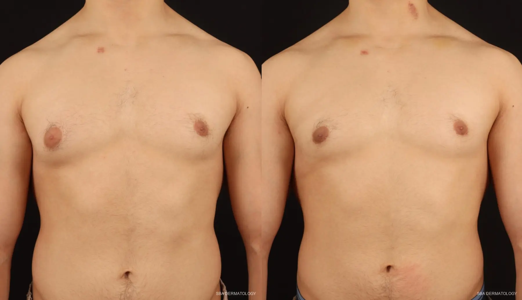 Gynecomastia: Patient 2 - Before and After 1