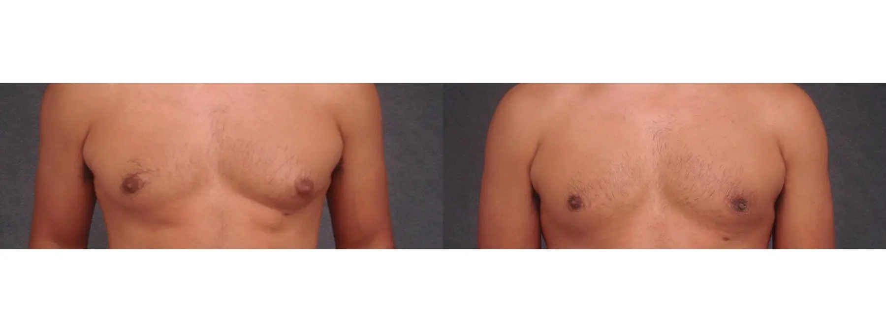 Gynecomastia: Patient 1 - Before and After 2