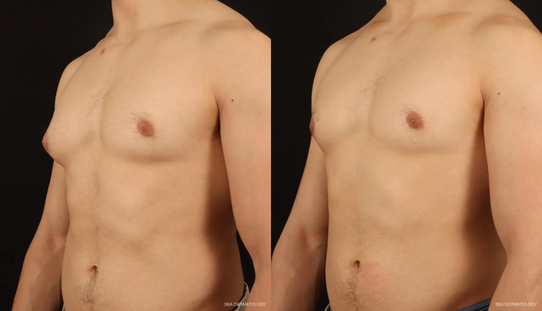 Gynecomastia: Patient 2 - Before and After 2