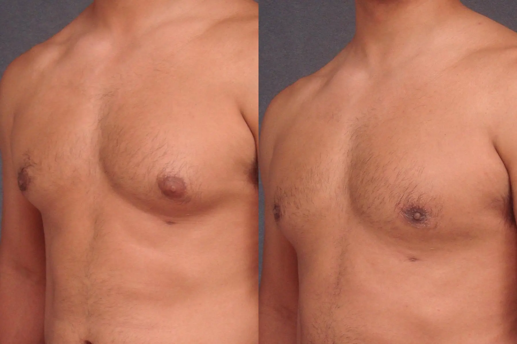 Gynecomastia: Patient 1 - Before and After 1