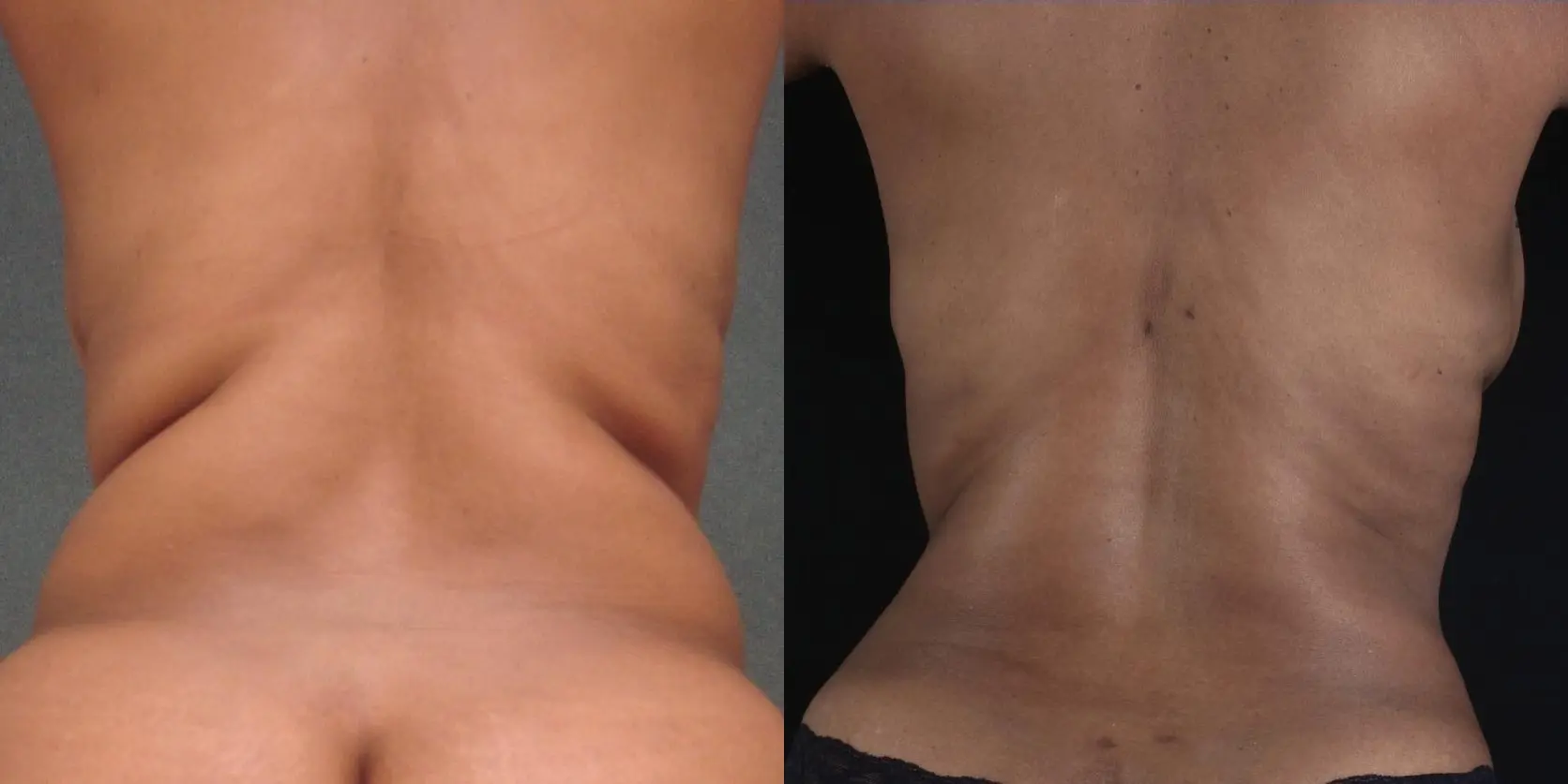 Liposuction: Patient 1 - Before and After  