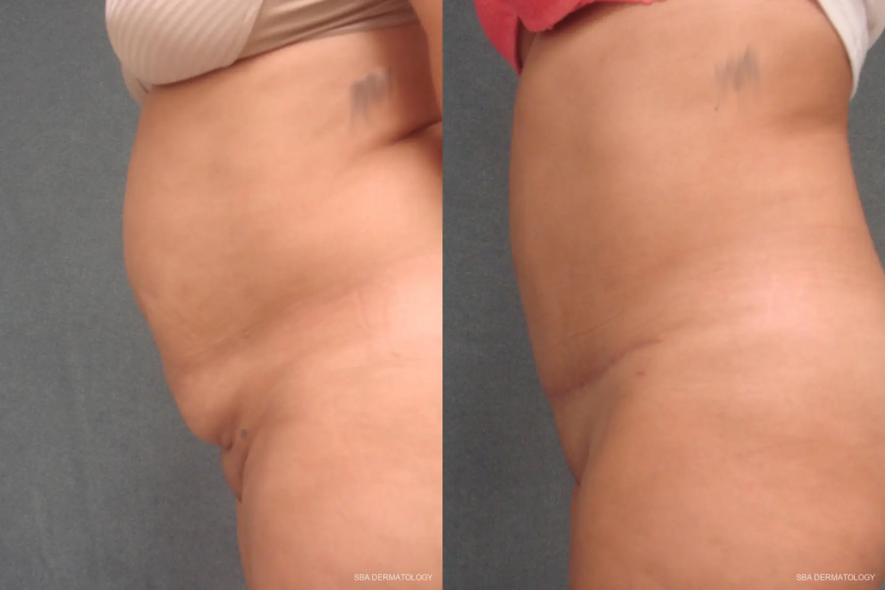 Tummy Tuck: Patient 2 - Before and After 2