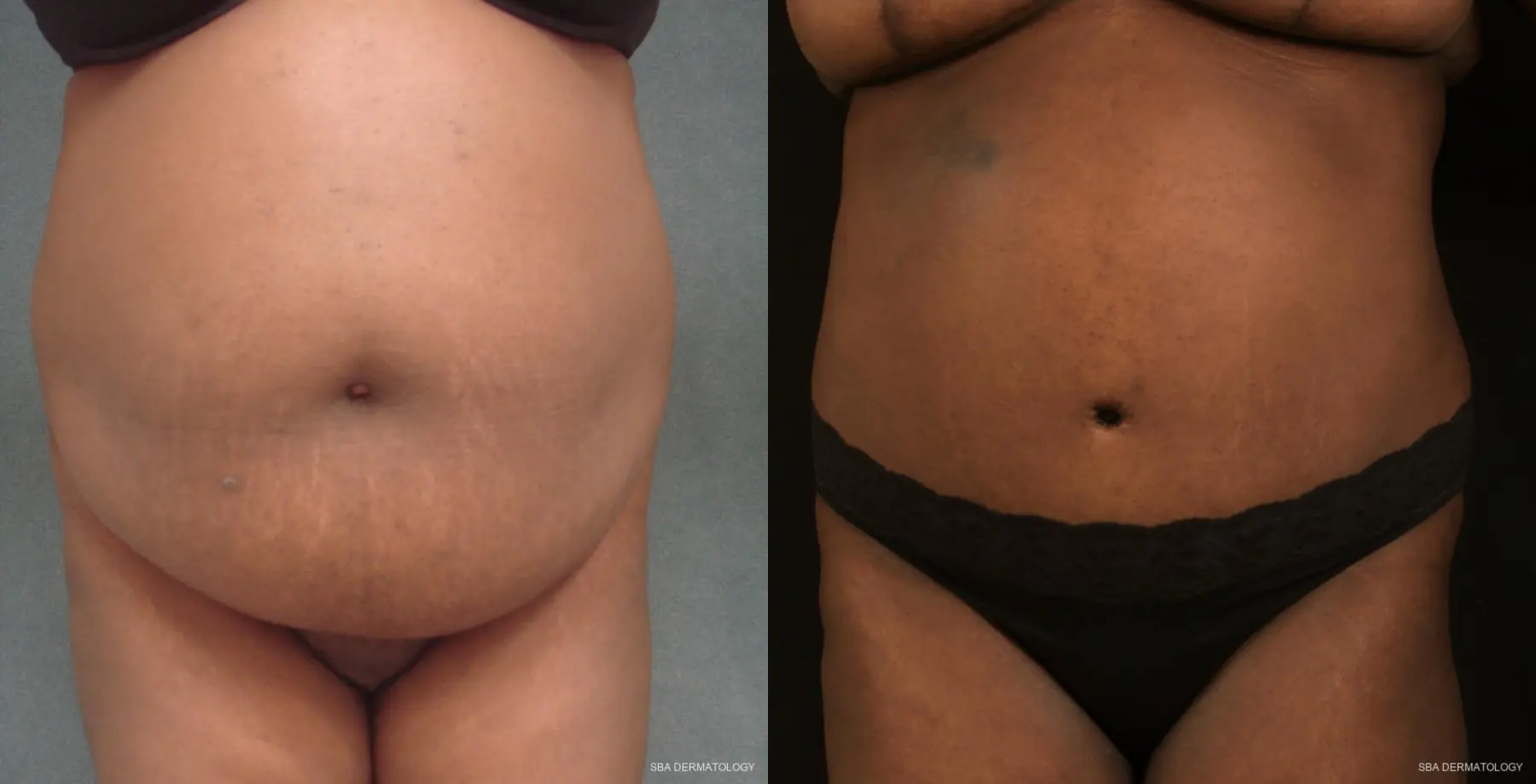 Tummy Tuck: Patient 3 - Before and After  