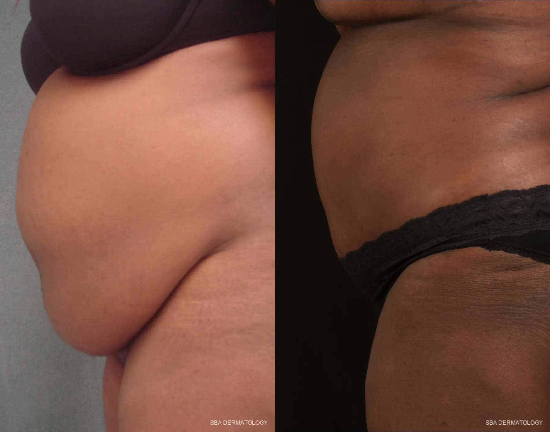 Tummy Tuck: Patient 3 - Before and After 2