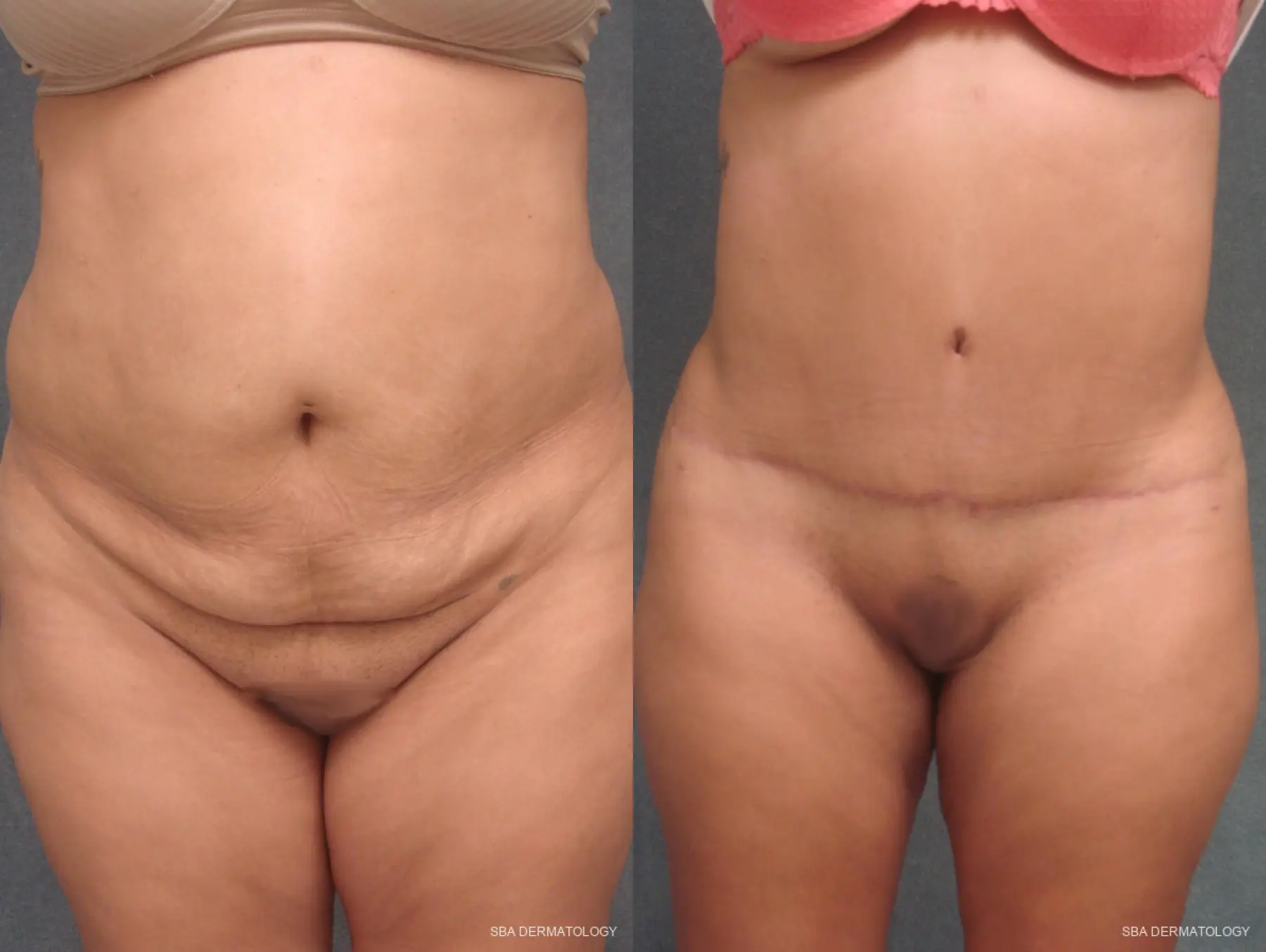 Tummy Tuck: Patient 2 - Before and After  