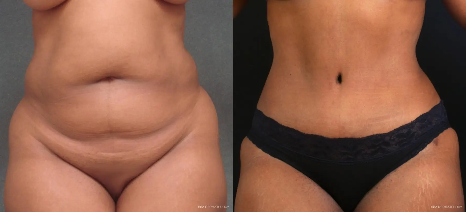 Tummy Tuck: Patient 4 - Before and After 1