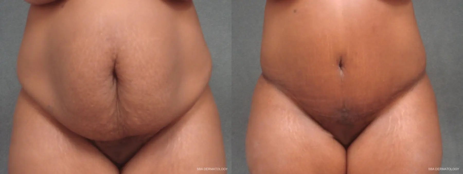 Tummy Tuck: Patient 1 - Before and After 1