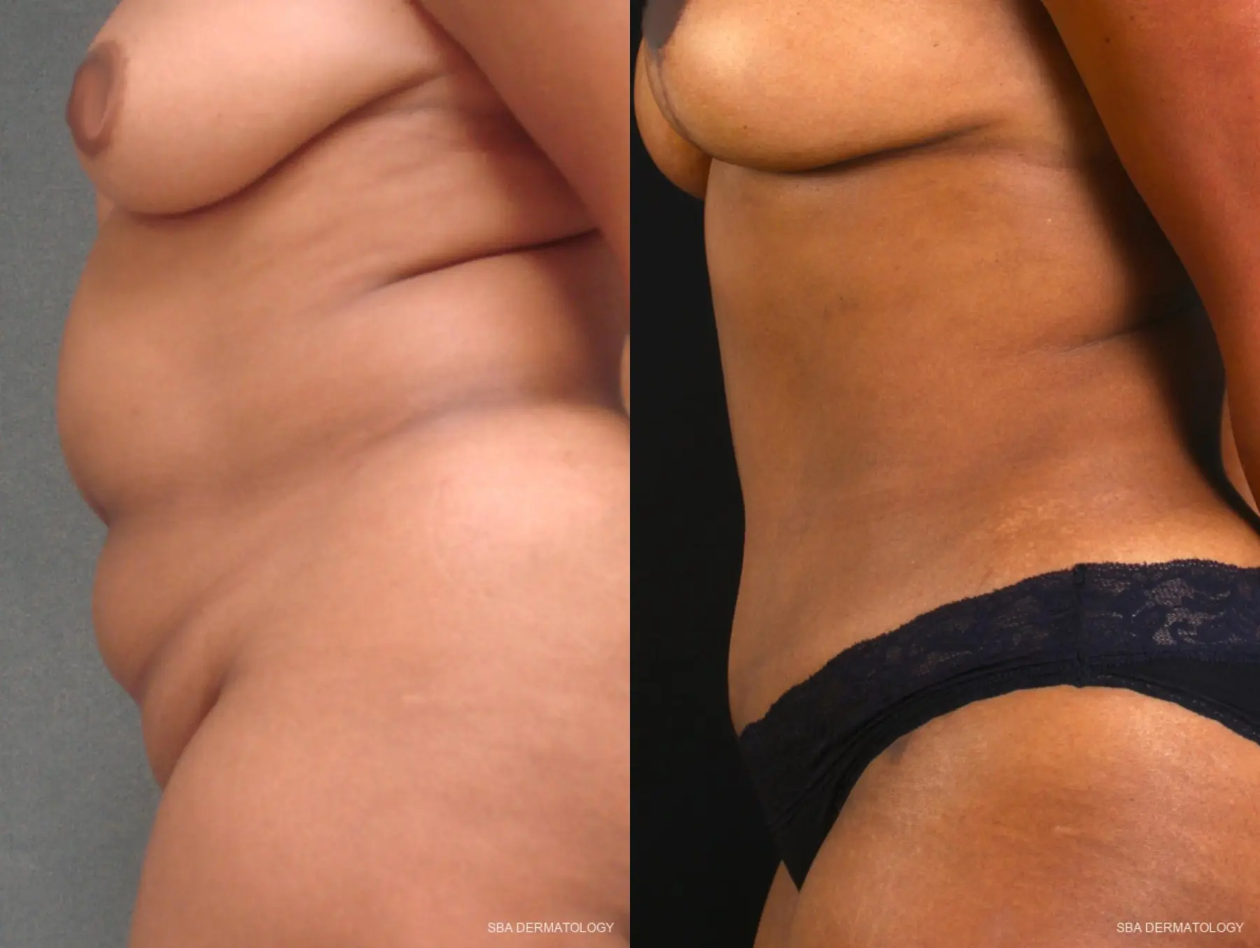 Tummy Tuck: Patient 4 - Before and After 2