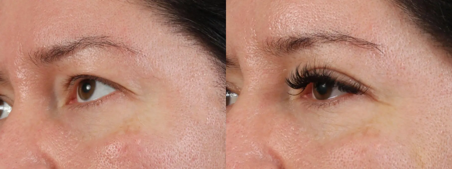 Upper Blepharoplasty: Patient 1 - Before and After 3