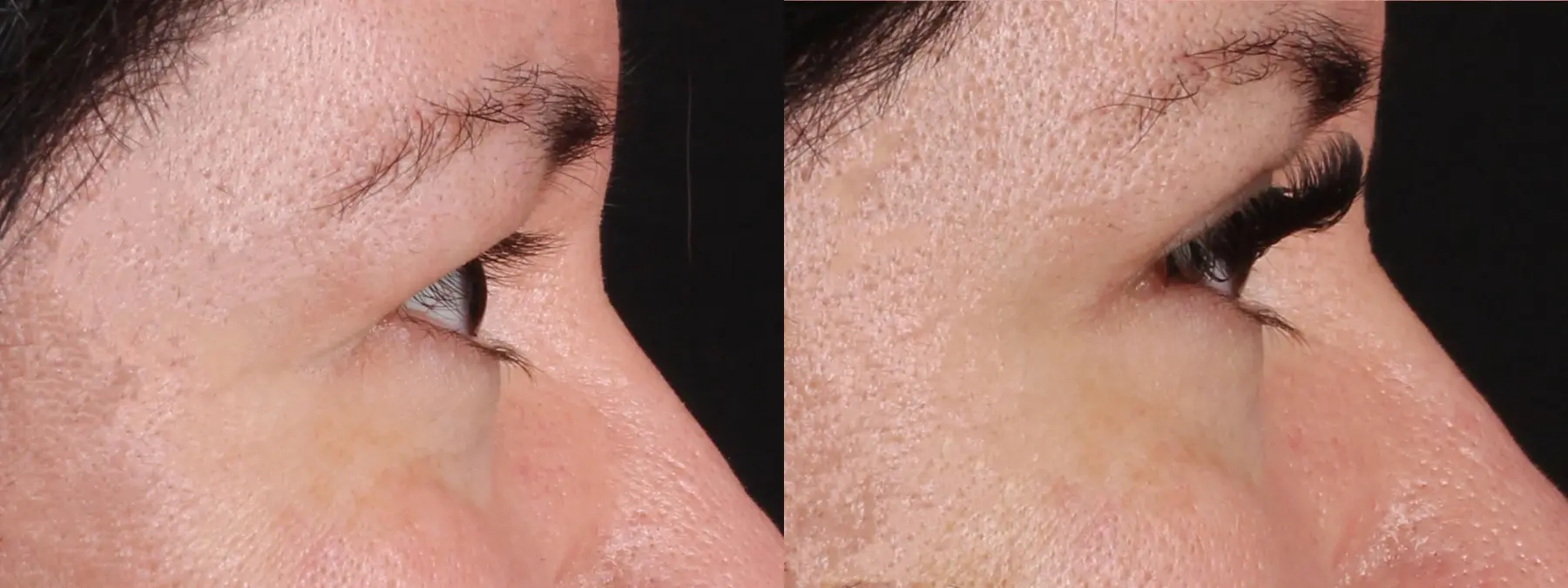 Upper Blepharoplasty: Patient 1 - Before and After 2