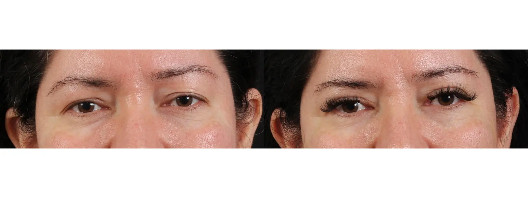 Upper Blepharoplasty: Patient 1 - Before and After  