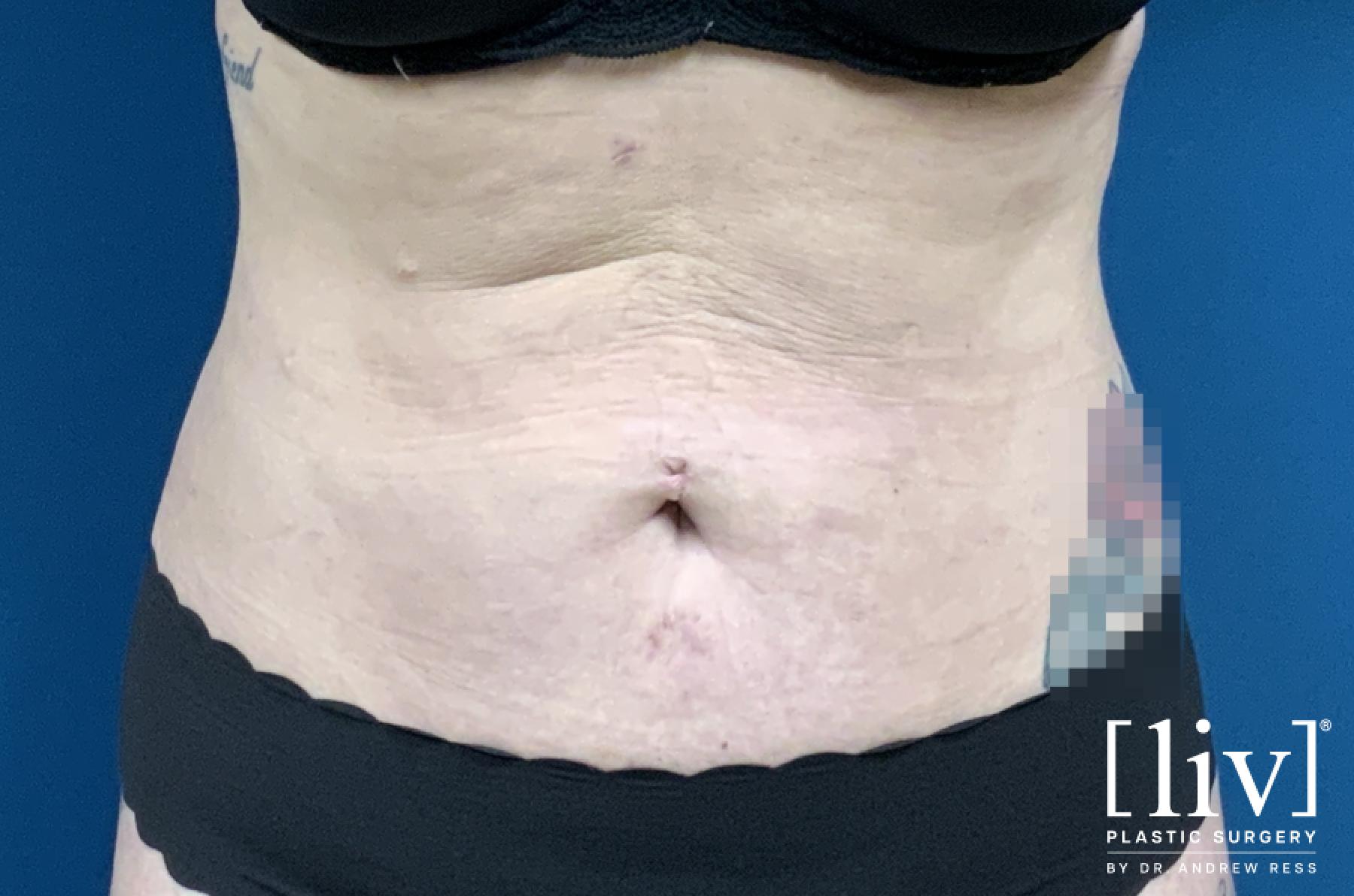Liposuction: Patient 15 - After 1