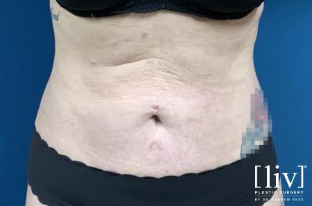 Liposuction: Patient 13 - After 1