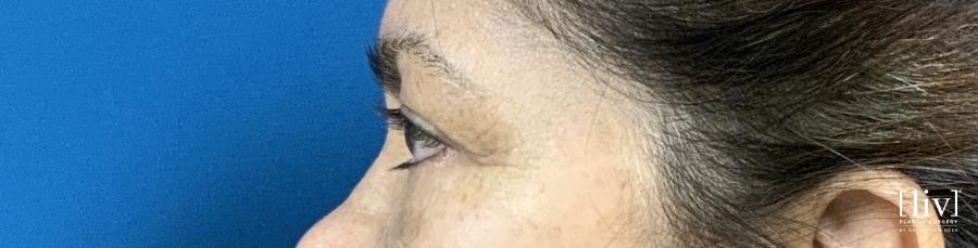 Upper Blepharoplasty - Before and After 3