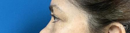Blepharoplasty: Patient 1 - Before and After 3