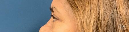 Upper Blepharoplasty - After 3