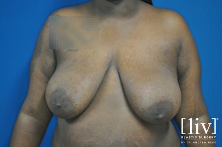 Breast Lift and Reduction - Before 5