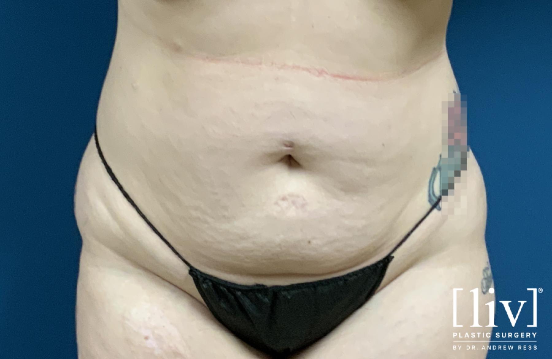 Liposuction: Patient 15 - Before 1