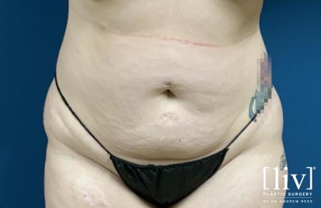 Liposuction: Patient 9 - Before 