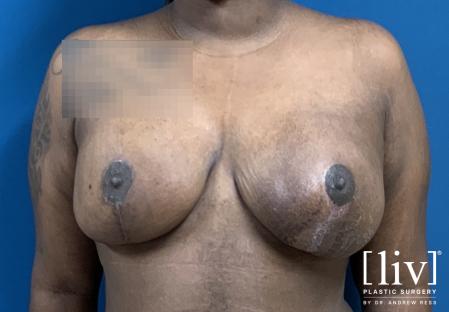 Breast Lift and Reduction - After 5