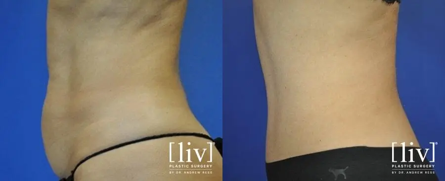 Abdominoplasty: Patient 8 - Before and After 5