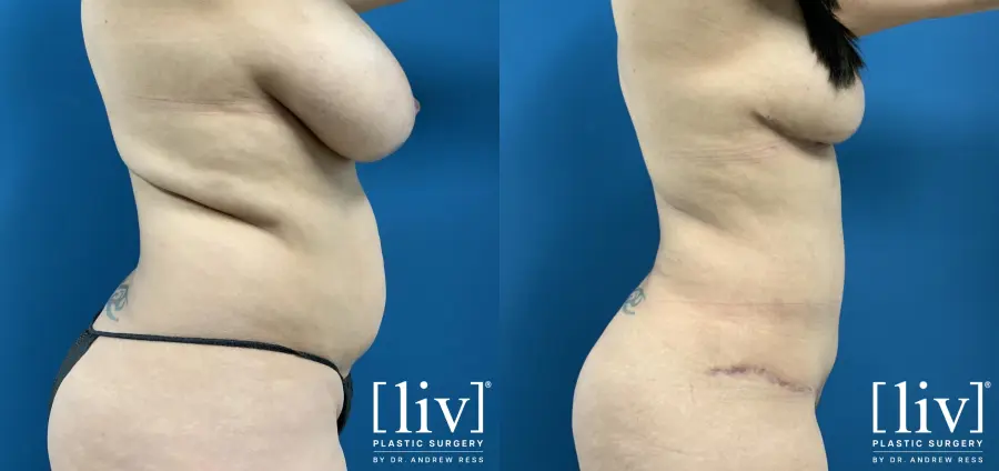 Lipoabdominoplasty - Before and After 5