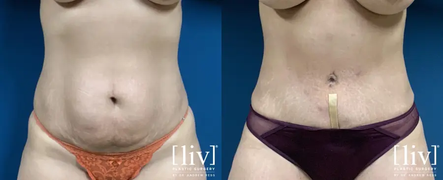 Lipoabdominoplasty - Before and After  