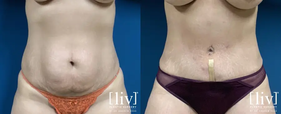 Lipoabdominoplasty - Before and After 1