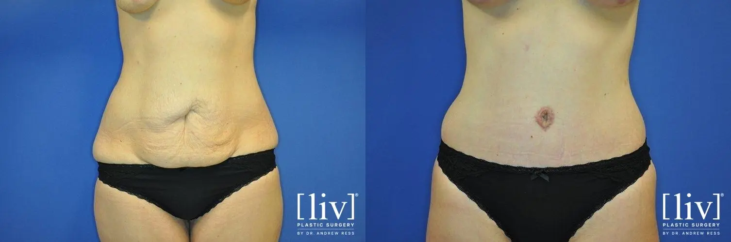 Abdominoplasty: Patient 15 - Before and After 1