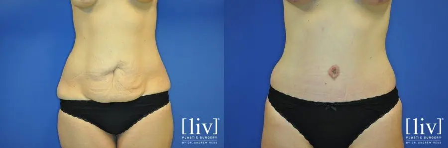Abdominoplasty: Patient 11 - Before and After 1