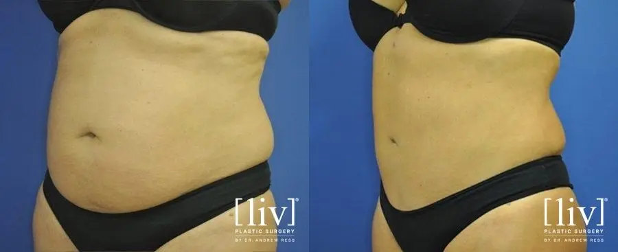 Abdominoplasty: Patient 6 - Before and After 4
