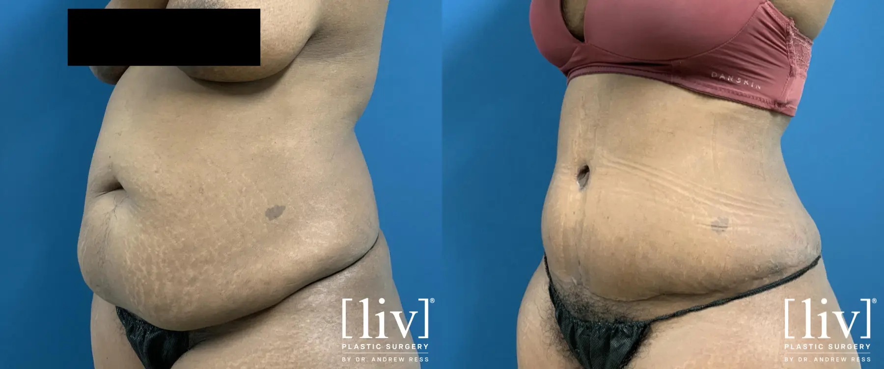 Abdominoplasty: Patient 11 - Before and After 2
