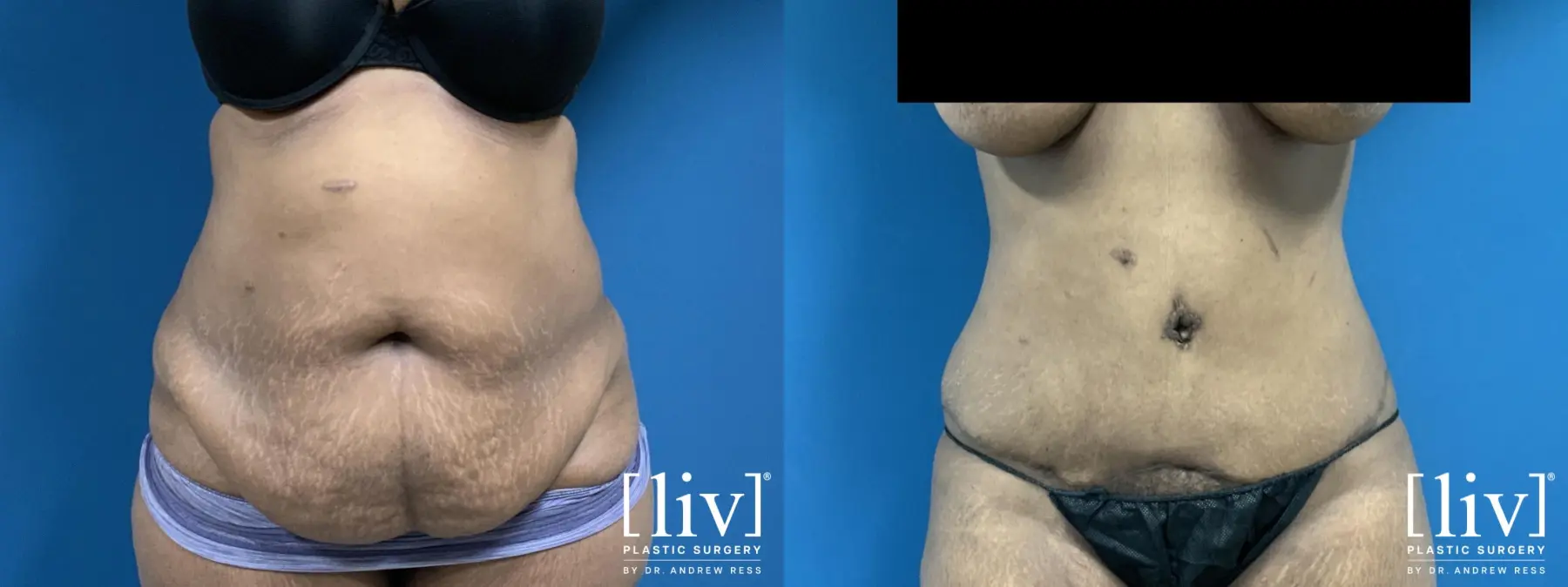 Lipoabdominoplasty - Before and After  