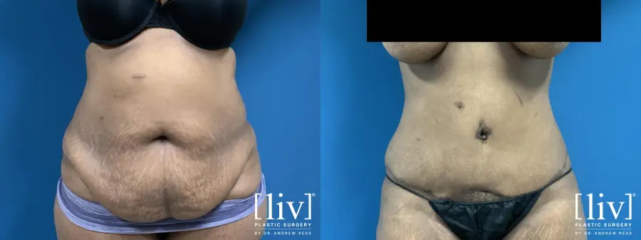 Abdominoplasty: Patient 1 - Before and After 1
