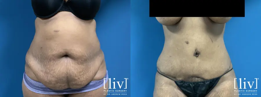 Lipoabdominoplasty - Before and After 1