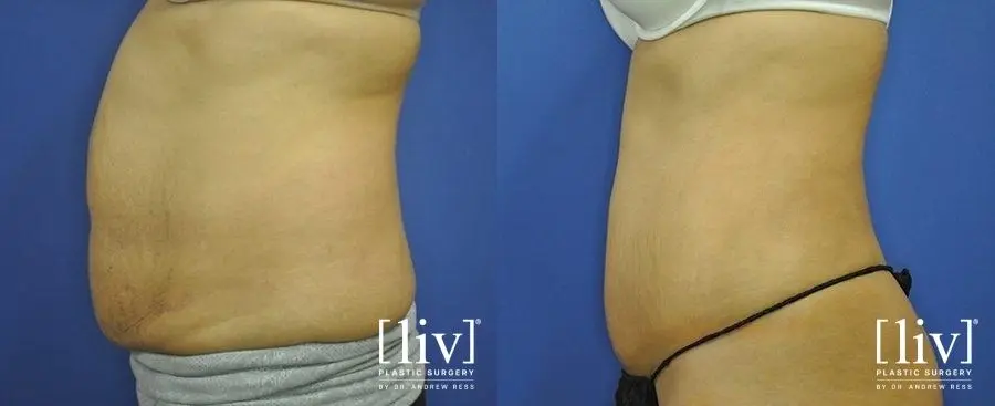 Abdominoplasty: Patient 7 - Before and After 5