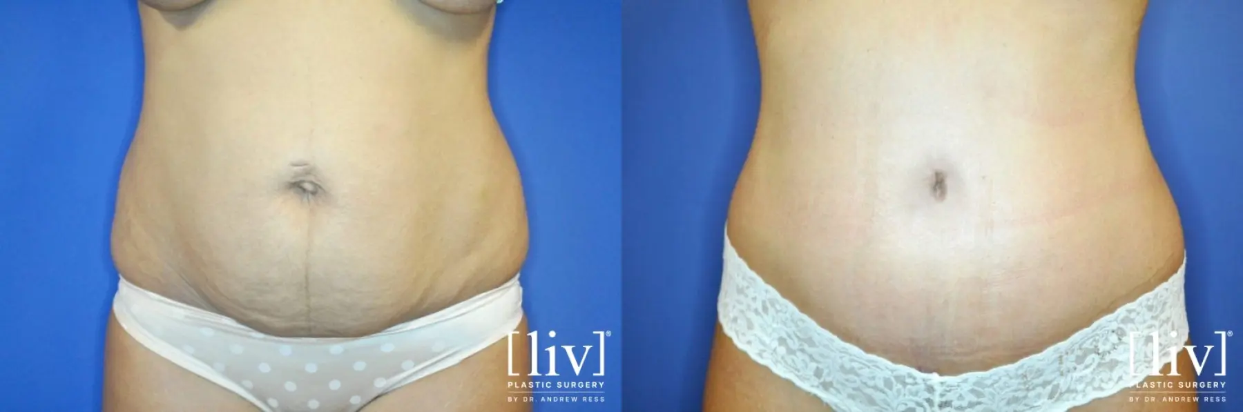 Abdominoplasty: Patient 5 - Before and After  