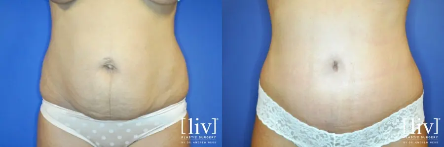 Abdominoplasty: Patient 4 - Before and After  