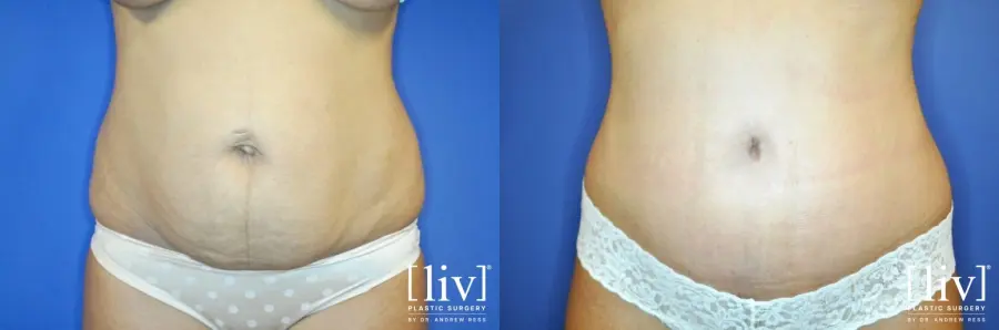 Abdominoplasty: Patient 4 - Before and After 1