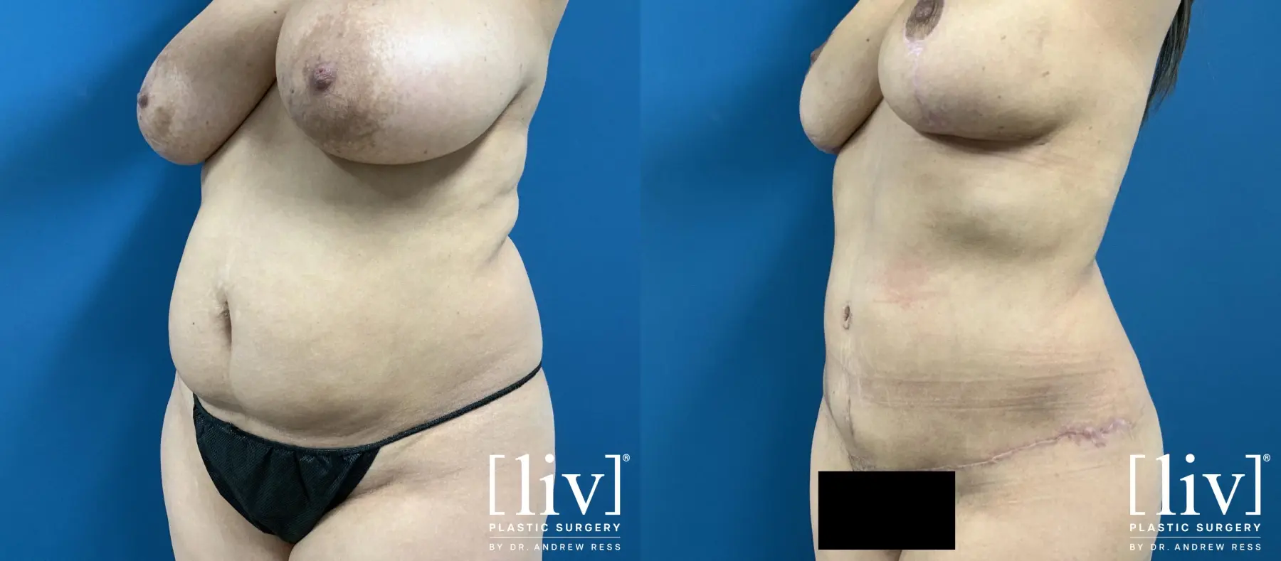 Lipoabdominoplasty - Before and After 2