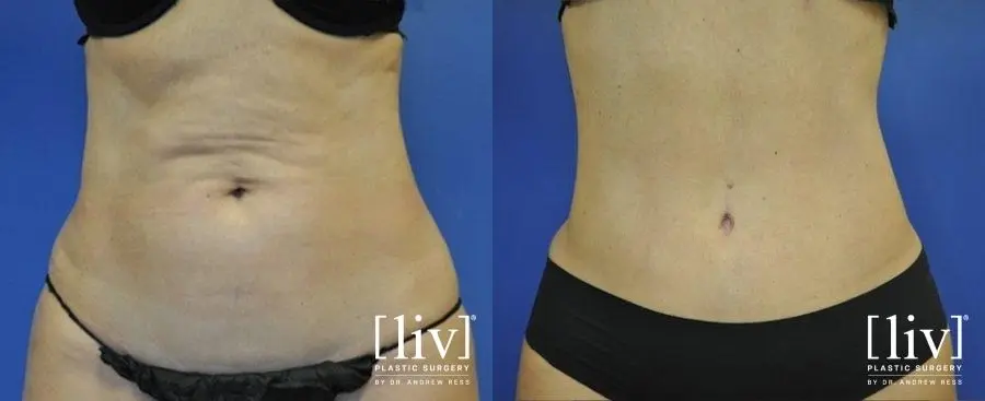 Abdominoplasty: Patient 8 - Before and After 1