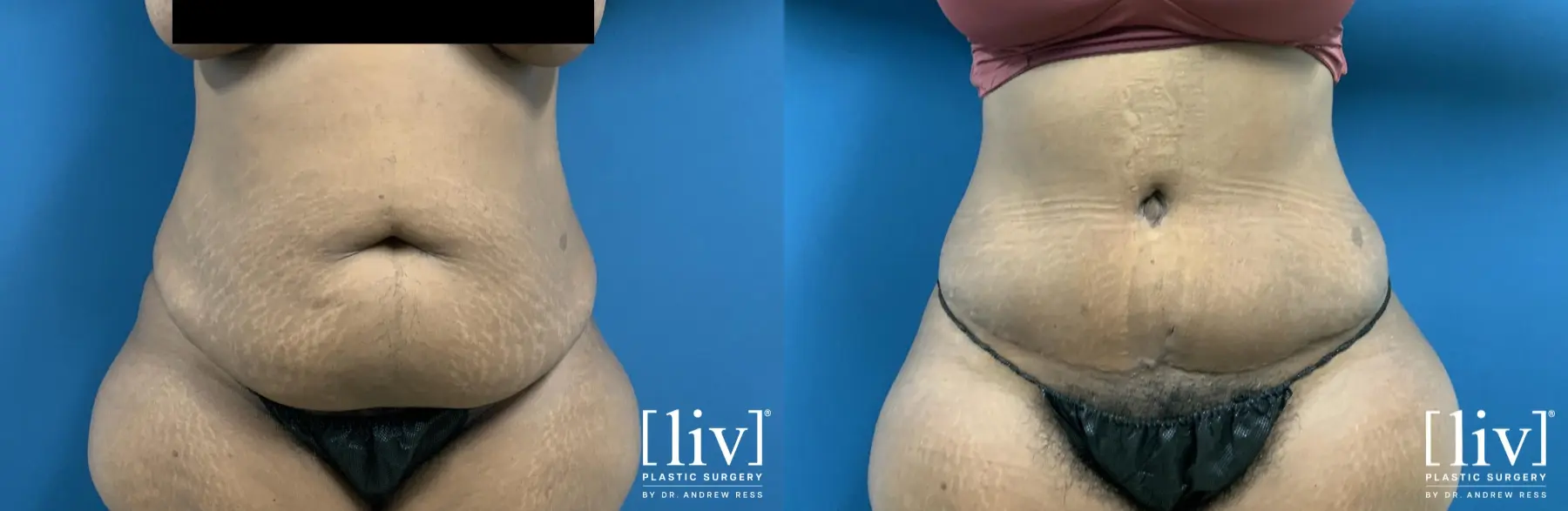 Abdominoplasty: Patient 11 - Before and After 1