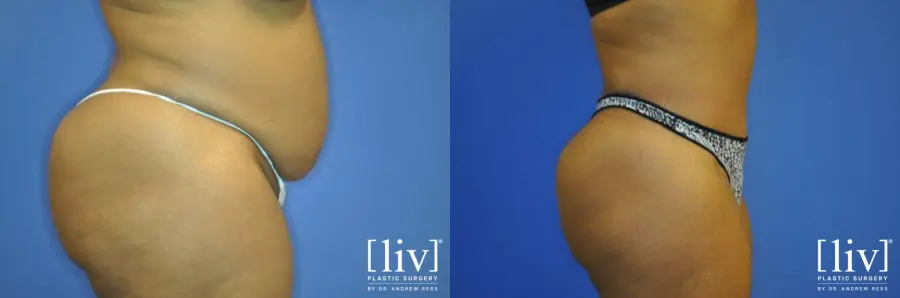 Lipoabdominoplasty - Before and After 2