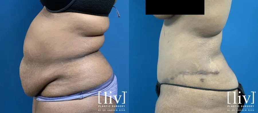 Lipoabdominoplasty - Before and After 5