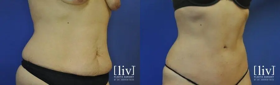 Abdominoplasty: Patient 9 - Before and After 2